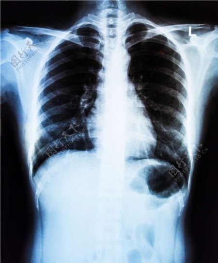 胸腔X光片图片