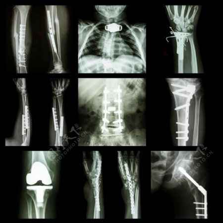 人体X光片图图片