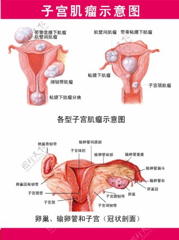 子宫肌瘤挂图