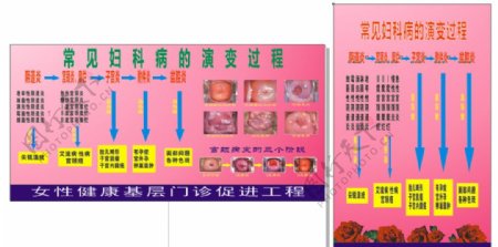 妇科病病变过程